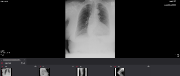 Confidential X-ray scan of chest lungs and leg along with patient details